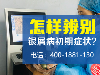 哈尔滨治疗银屑病需要花多少钱