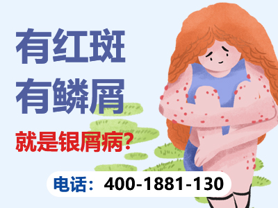 哈尔滨专治银屑病效果好的医院