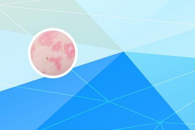 黑龙江好的银屑病医院在哪里