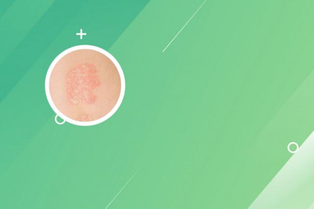 黑龙江治牛皮癣的专家