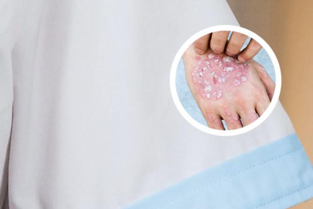 黑龙江治银屑病用什么药好